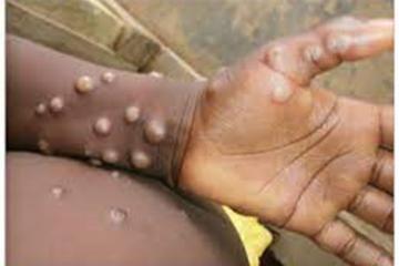 Monkeypox.jpg