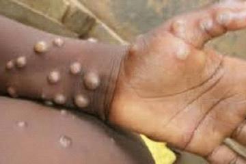 Deux cas de mpox