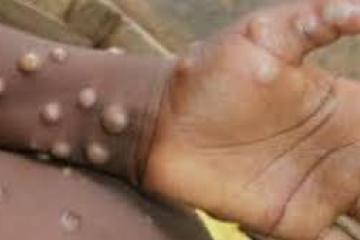 Mpox