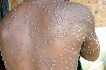 Une vue du dos d'une personne souffrant de Mpox.