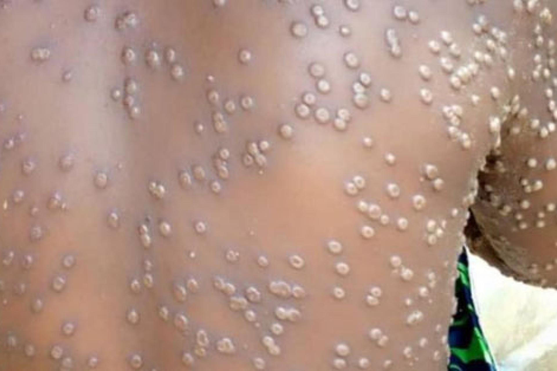 m-pox.jpg
