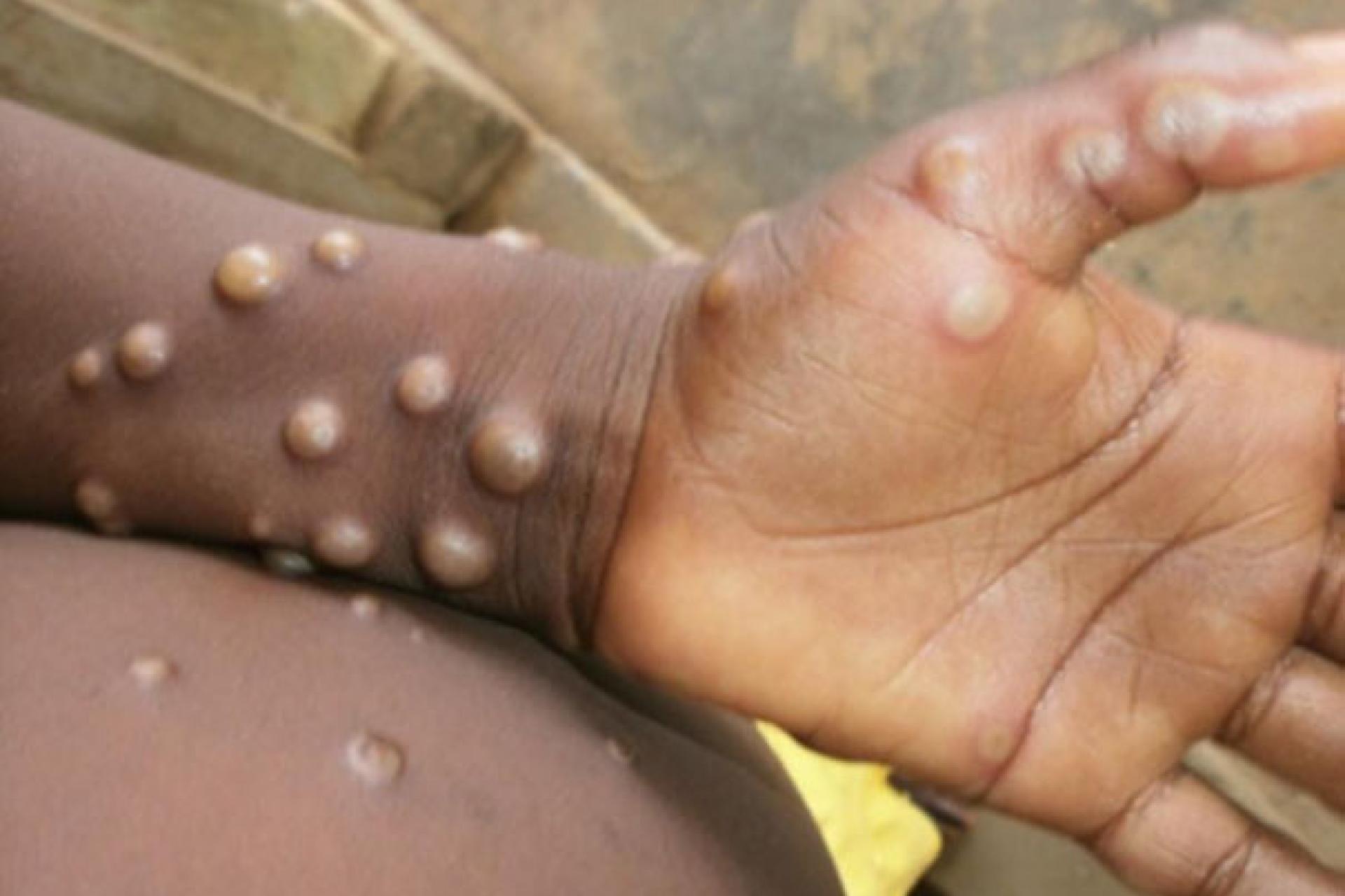 Mpox hand